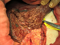 肝腫瘍
