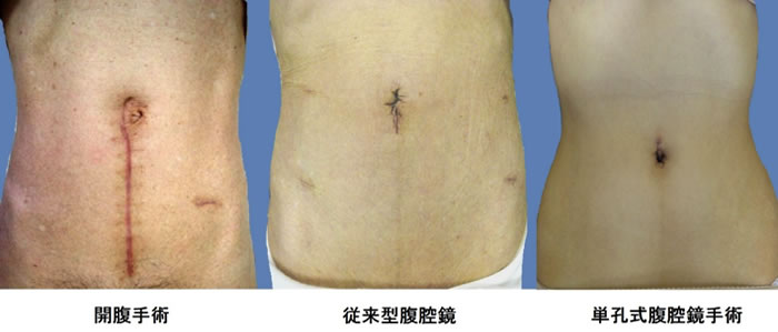 開腹手術・従来型腹腔鏡・単孔式腹腔鏡手術