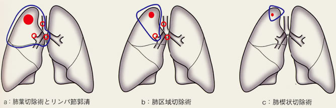 肺区域切除術①