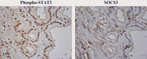 胆管癌ではIL6-JAK/STAT3 pathwayが亢進 * 