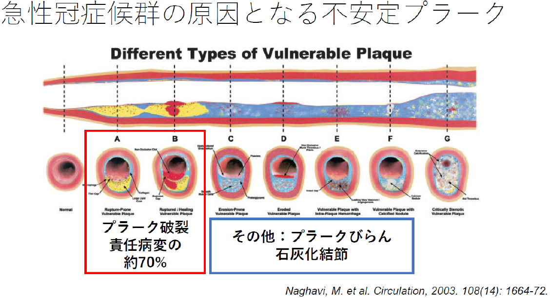 急性冠症候群の原因となる不安定プラーク