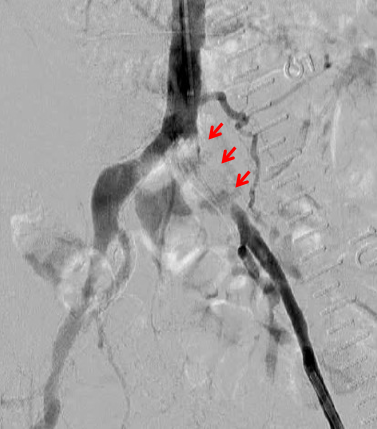 左腸骨動脈の閉塞