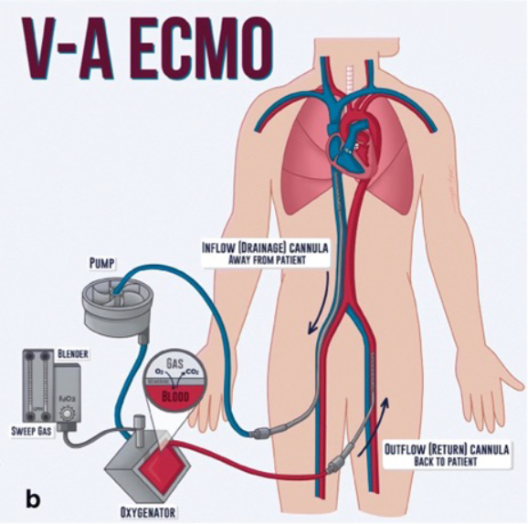 （ECMO　文献3より引用）