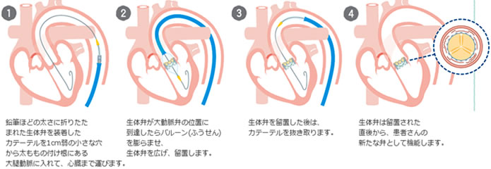 経大腿アプローチ