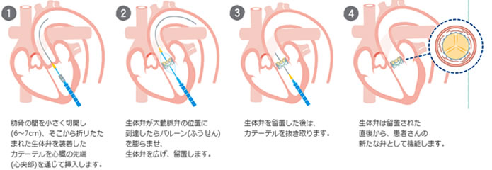 経心尖アプローチ