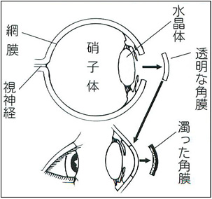 角膜移植