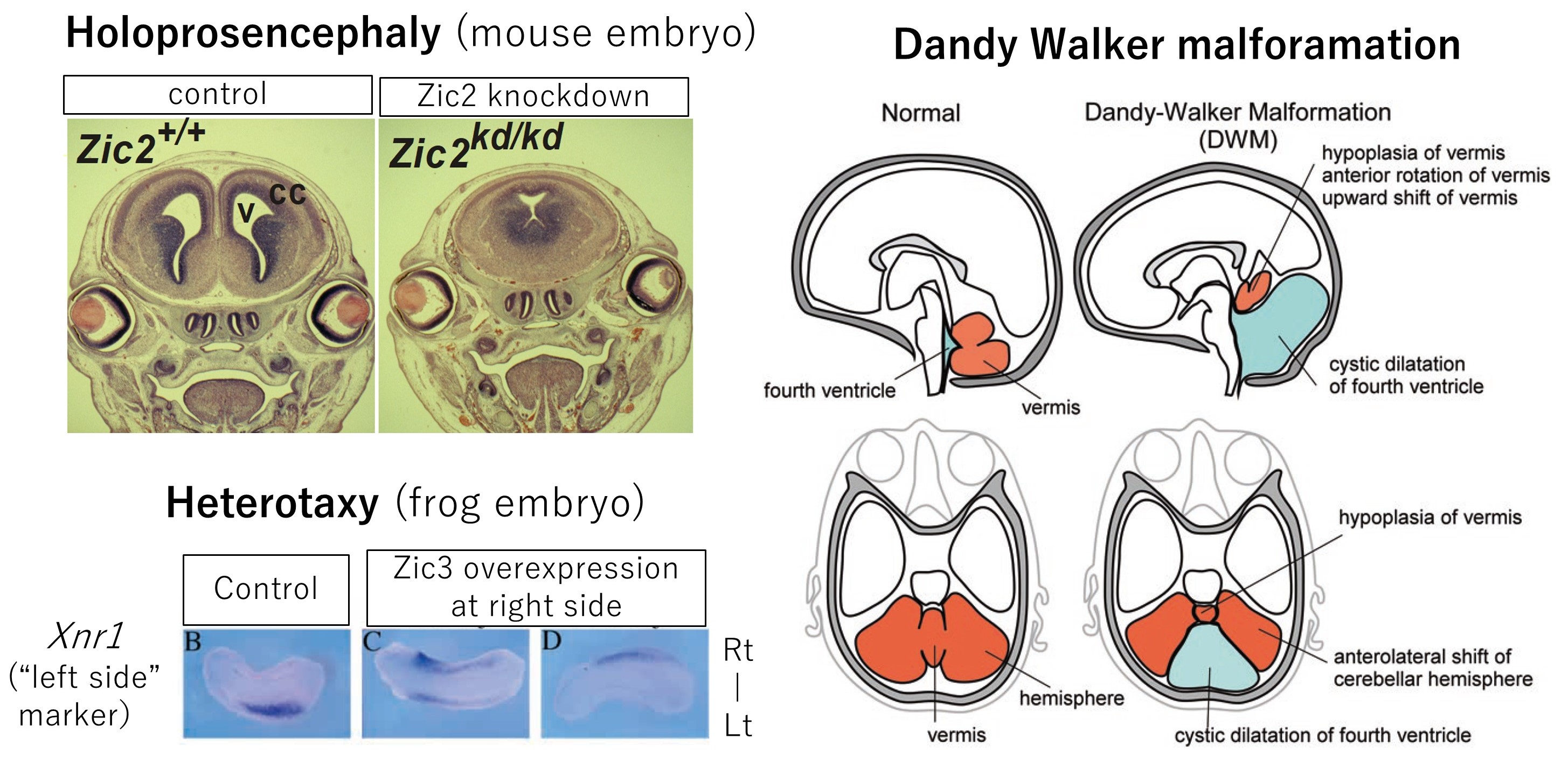 Malformatioins associated with mutations of Zic family genes