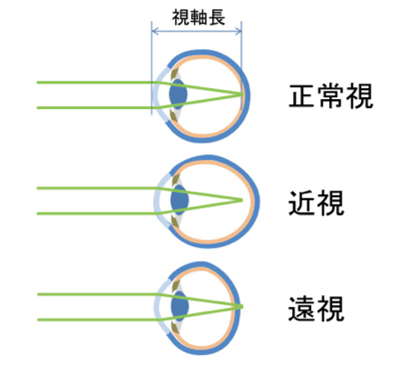 図1 近視、遠視、正常視の関係