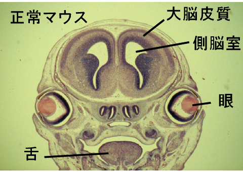 全 前 脳 胞症