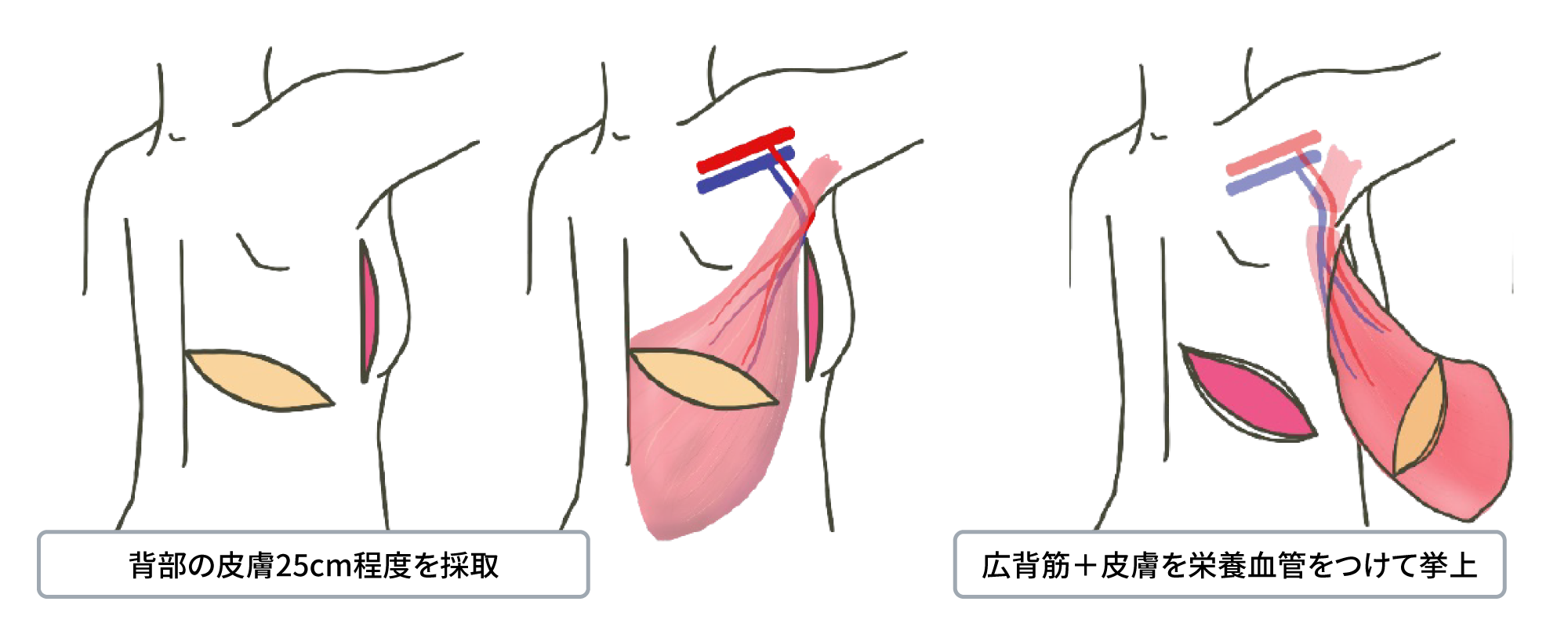 動脈皮弁術及び筋皮弁を用いた乳房再建術（広背筋皮弁術）① 広背筋皮弁の挙上