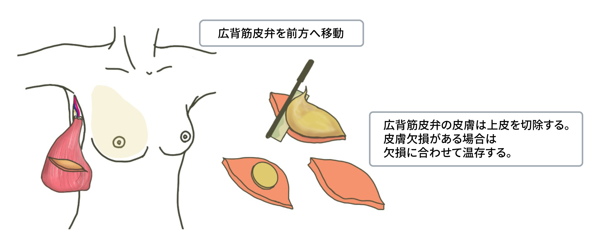 動脈皮弁術及び筋皮弁を用いた乳房再建術（広背筋皮弁術）③ 筋皮弁の固定