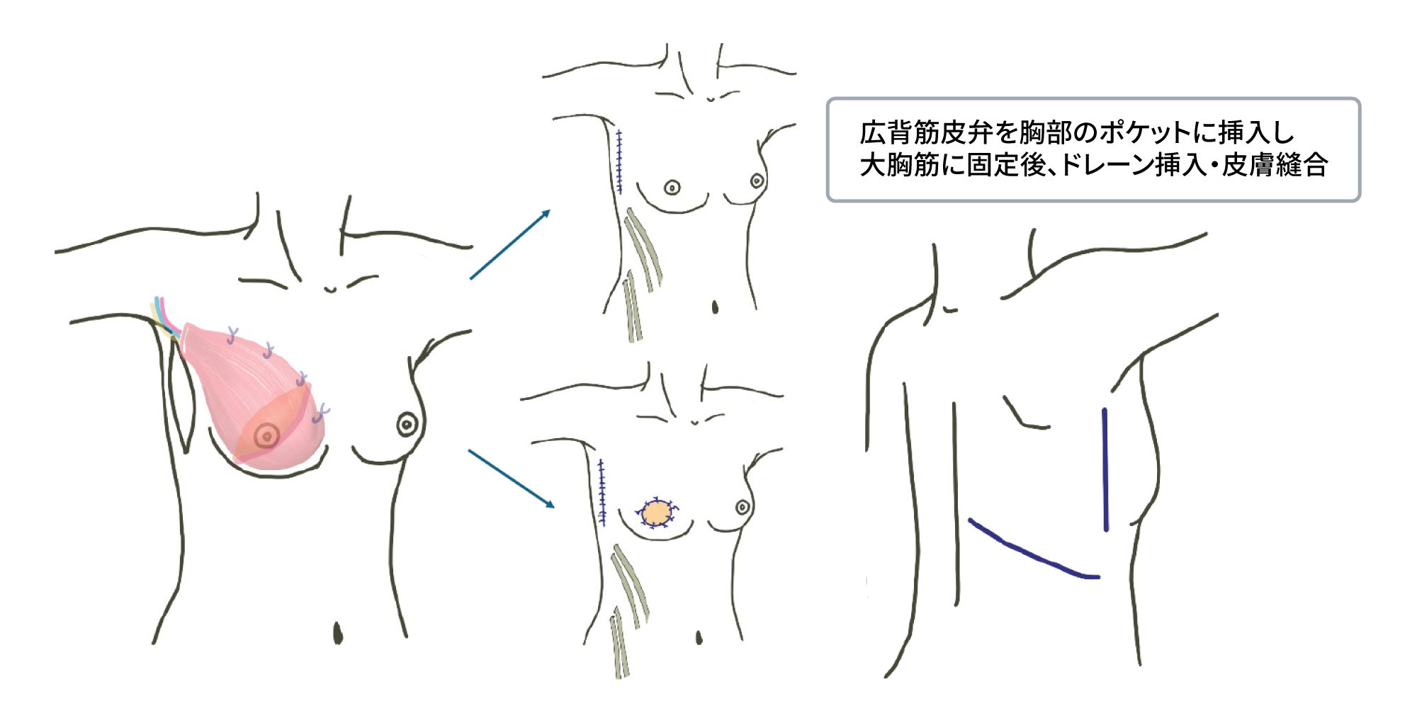 動脈皮弁術及び筋皮弁を用いた乳房再建術（広背筋皮弁術）④ 閉創