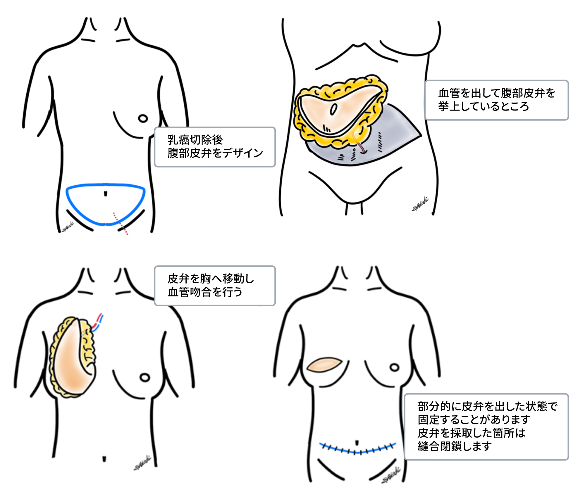 乳癌に対する一次一期乳房再建（遊離腹部皮弁での再建）手術方法