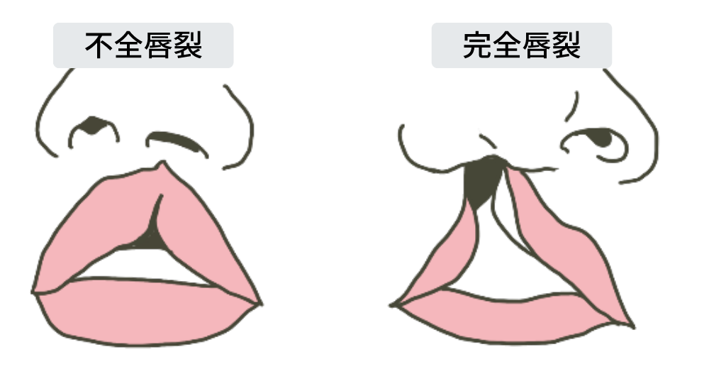 口唇裂（完全唇裂・不全唇裂）