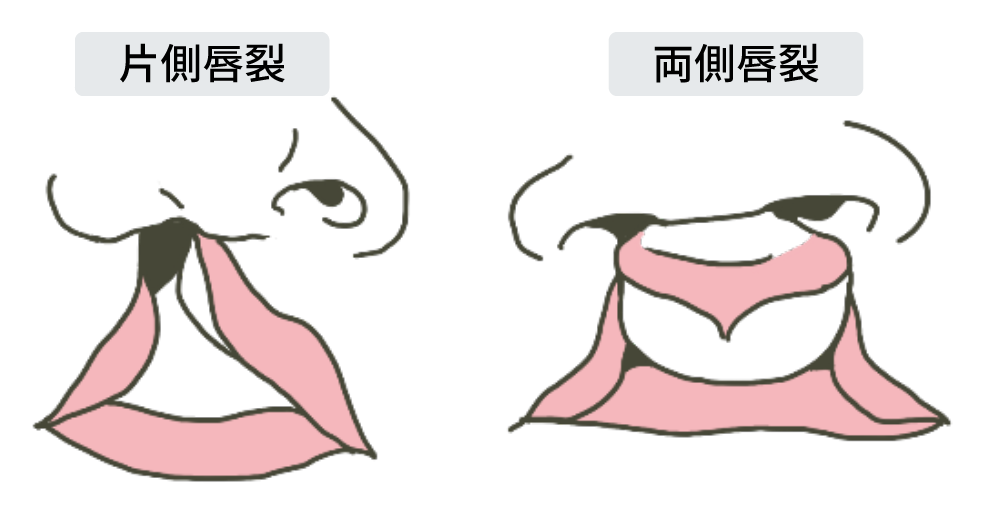 口唇裂（両側唇裂・片側唇裂）