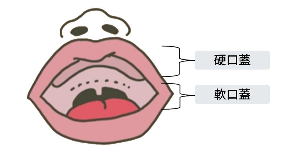 口蓋裂（硬口蓋・軟口蓋）