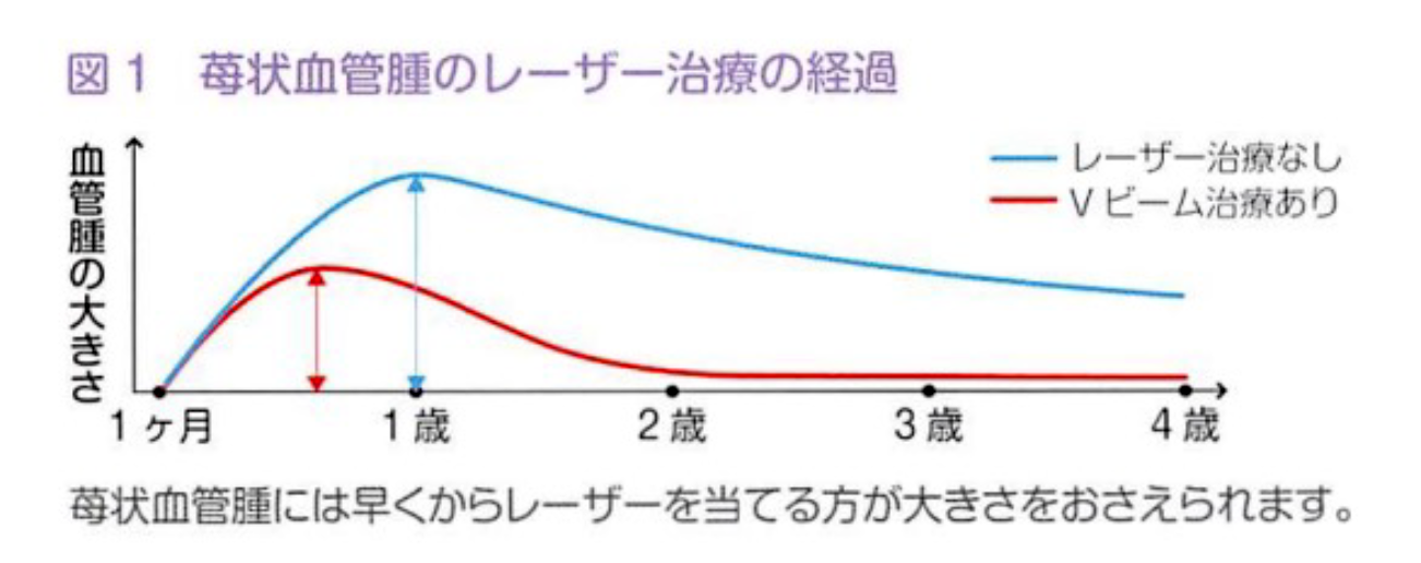 色素レーザー照射法：苺状血管腫のレーザー治療の経過