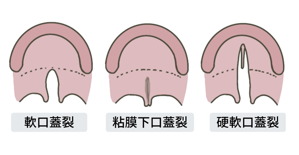 口蓋裂（軟口蓋裂・粘膜下口蓋裂・硬軟口蓋裂）