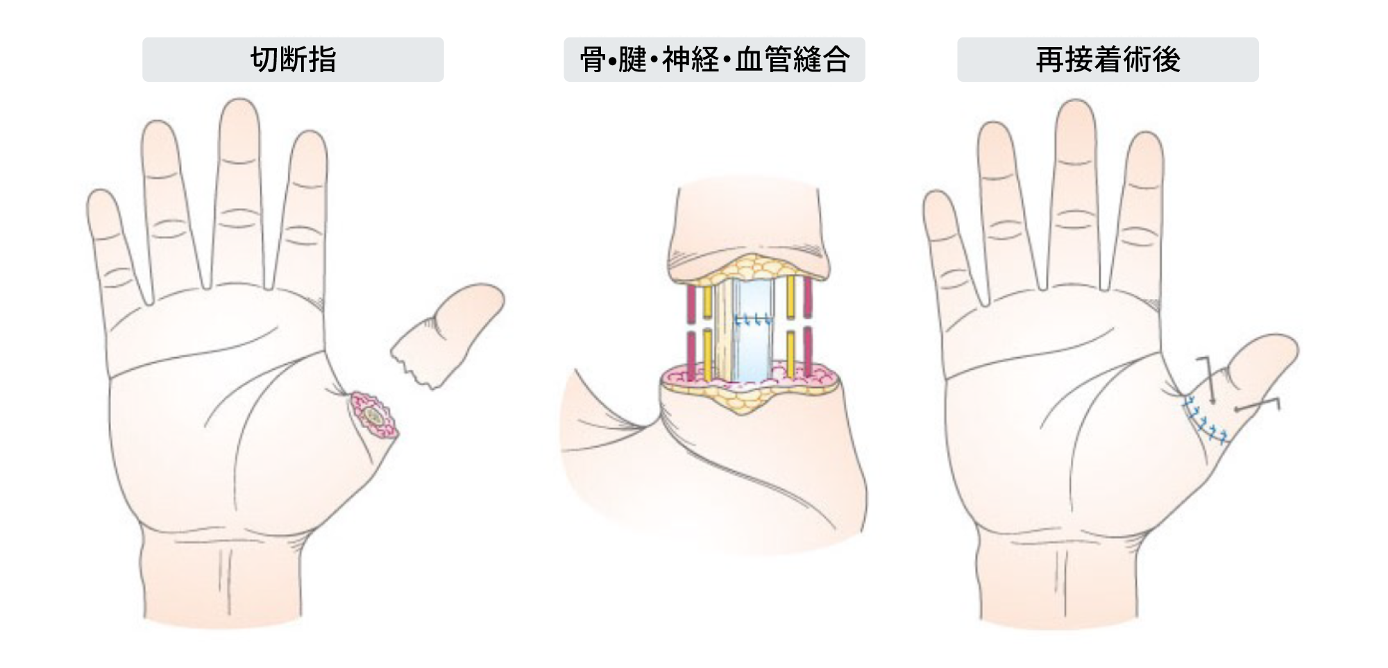 切断指、骨•腱・神経・血管縫合、再接着術後