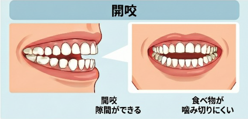開咬