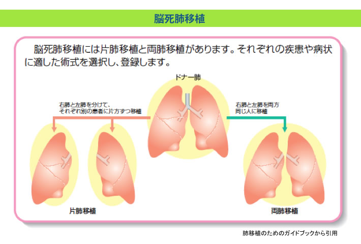 脳死肺移植