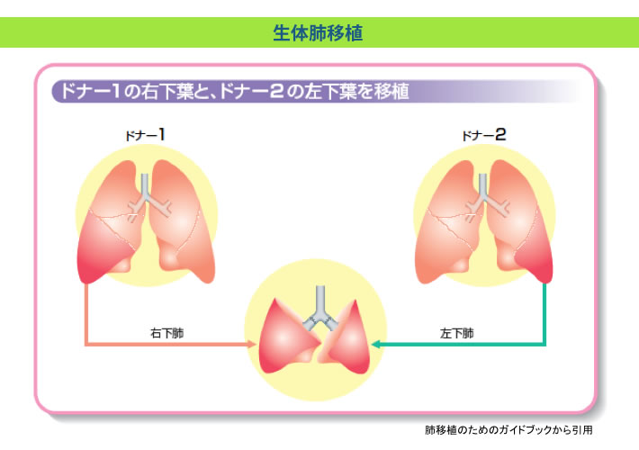 脳死肺移植