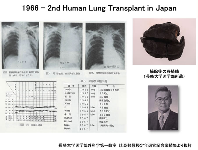 1966-2nd Human Lung Transplant in Japan