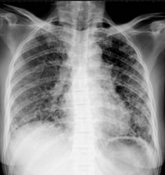 移植前の肺