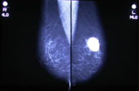 乳癌のマンモグラフィ像