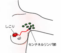 色素に染色されたリンパ管とリンパ節