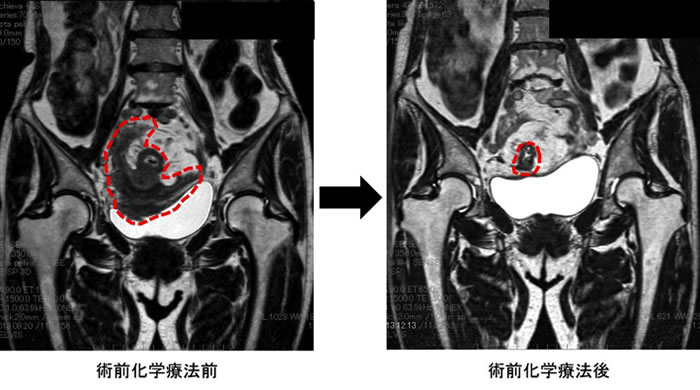 術前化学療法前→術前化学療法後