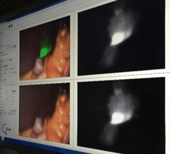 図２: 転移性肝腫瘍におけるImage-guided surgery